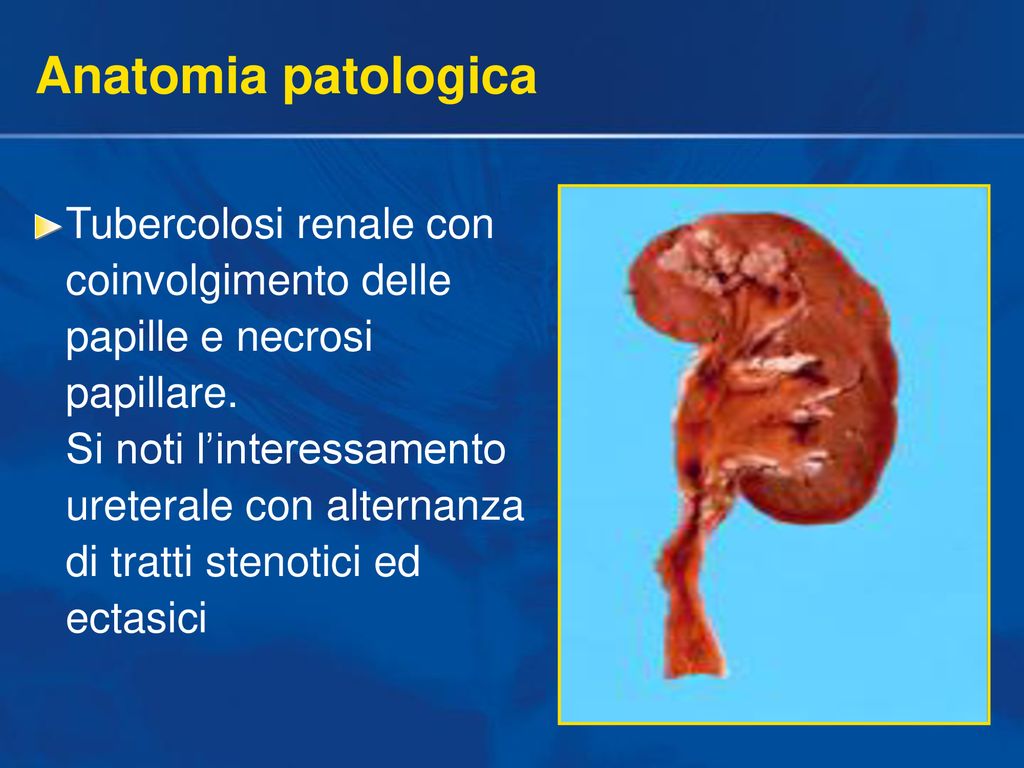 Tubercolosi Genito Urinaria Ppt Scaricare